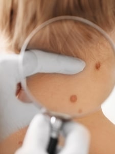 Dépistage des cancers de la peau – examen dermatologique d’un grain de beauté